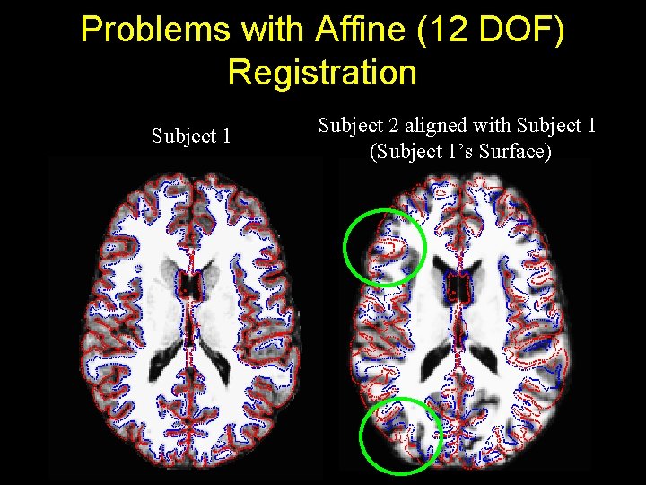 Problems with Affine (12 DOF) Registration Subject 1 Subject 2 aligned with Subject 1