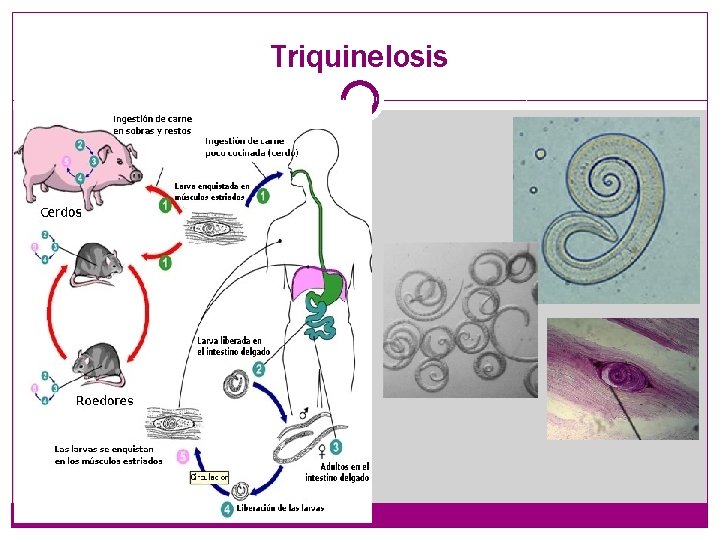 Triquinelosis 