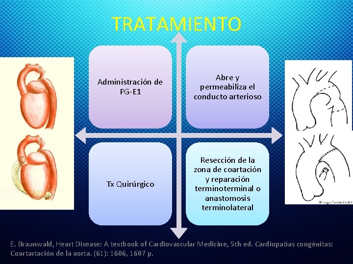 TRATAMIENTO Administración de PG-E 1 Abre y permeabiliza el conducto arterioso Tx Quirúrgico Resección