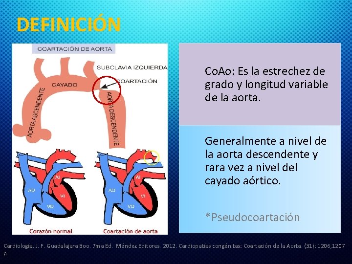 DEFINICIÓN Co. Ao: Es la estrechez de grado y longitud variable de la aorta.