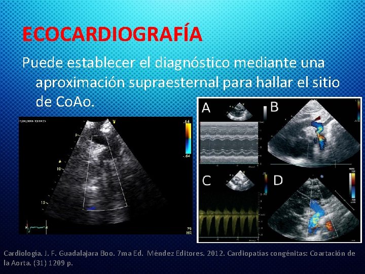 ECOCARDIOGRAFÍA Puede establecer el diagnóstico mediante una aproximación supraesternal para hallar el sitio de