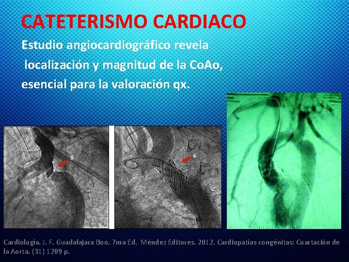 CATETERISMO CARDIACO Estudio angiocardiográfico revela localización y magnitud de la Co. Ao, esencial para