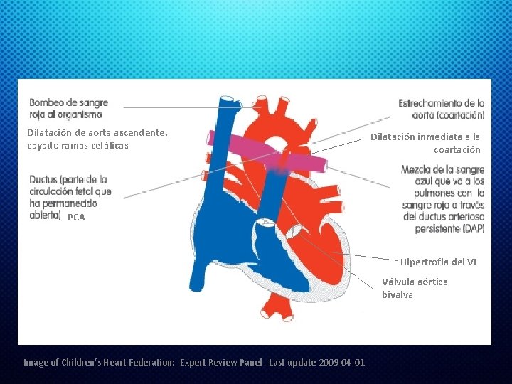 Dilatación de aorta ascendente, cayado ramas cefálicas Dilatación inmediata a la coartación PCA Hipertrofia