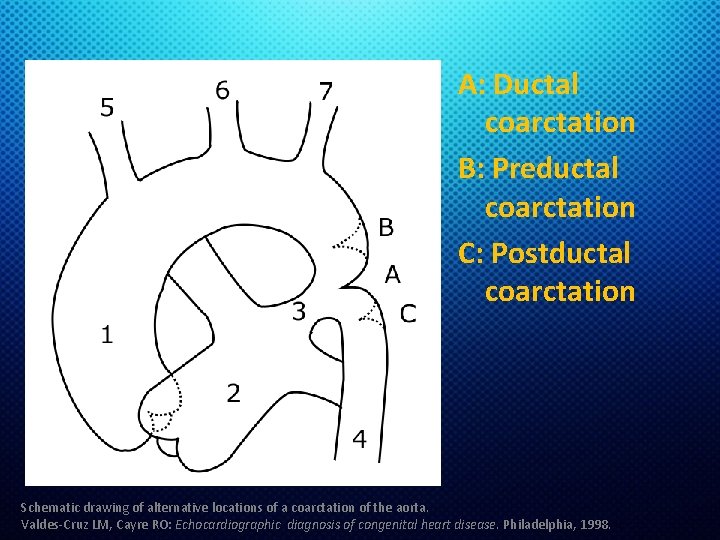 A: Ductal coarctation B: Preductal coarctation C: Postductal coarctation Schematic drawing of alternative locations