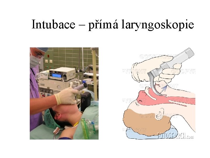 Intubace – přímá laryngoskopie 
