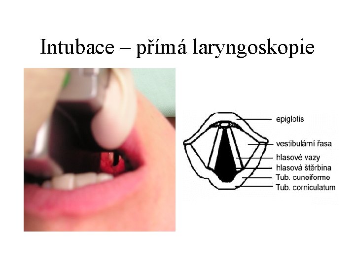 Intubace – přímá laryngoskopie 