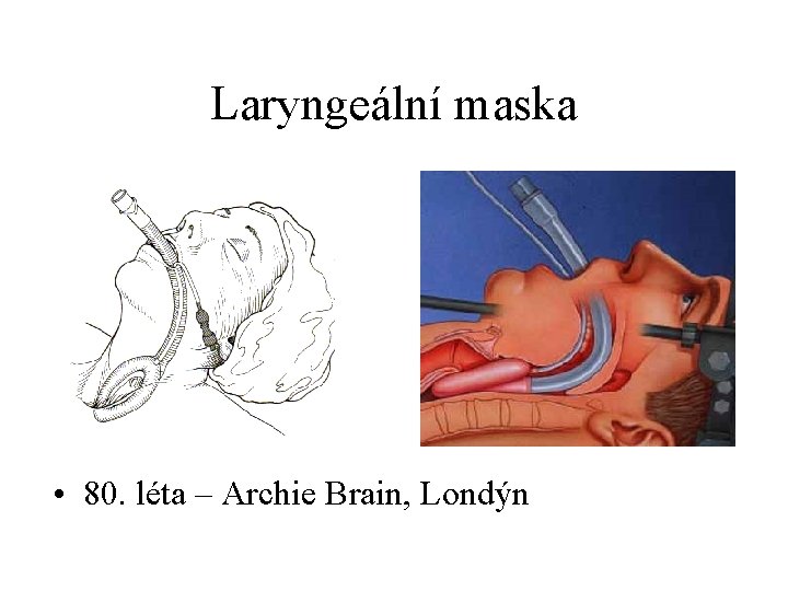 Laryngeální maska • 80. léta – Archie Brain, Londýn 