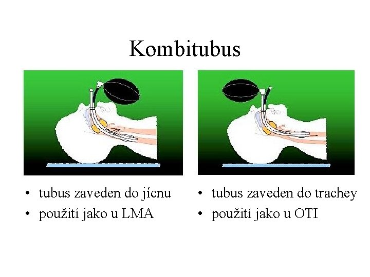 Kombitubus • tubus zaveden do jícnu • použití jako u LMA • tubus zaveden