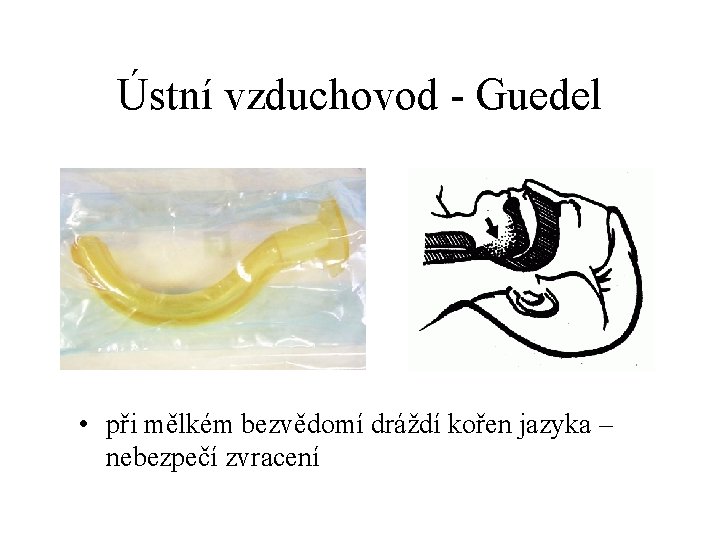 Ústní vzduchovod - Guedel • při mělkém bezvědomí dráždí kořen jazyka – nebezpečí zvracení