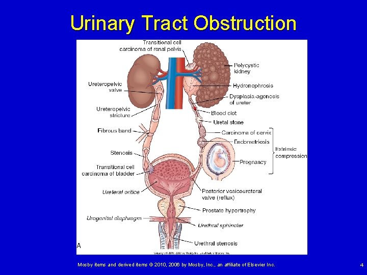 Chapter 36 Alterations of Renal and Urinary Tract