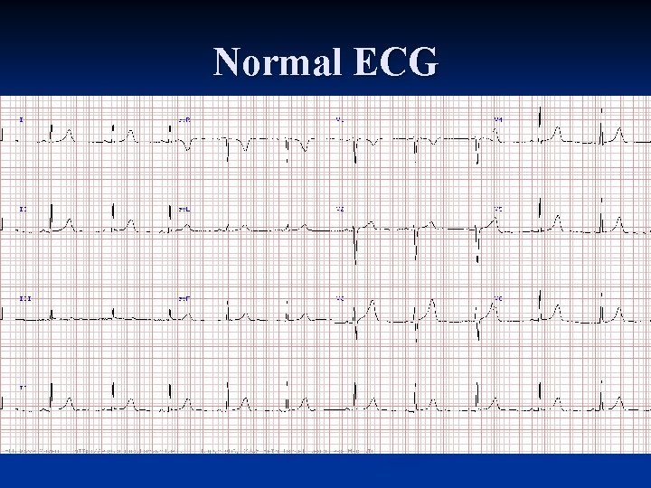 Normal ECG 