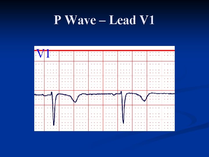 P Wave – Lead V 1 