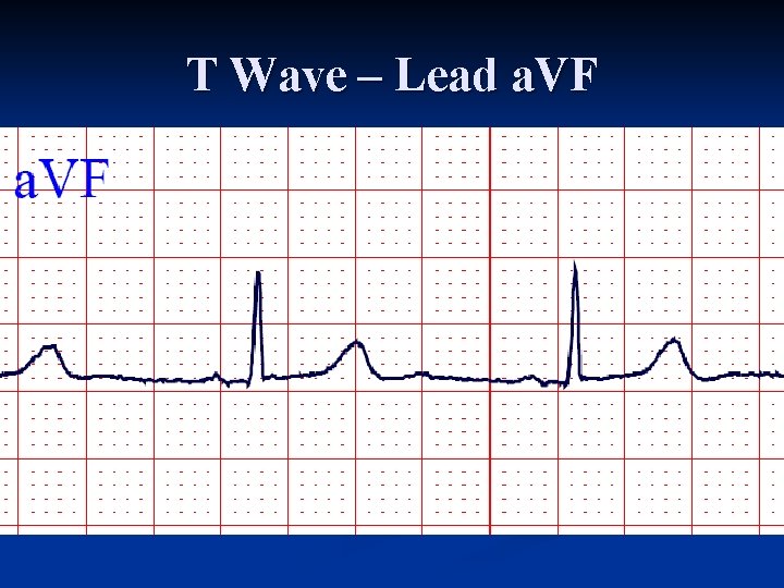 T Wave – Lead a. VF 