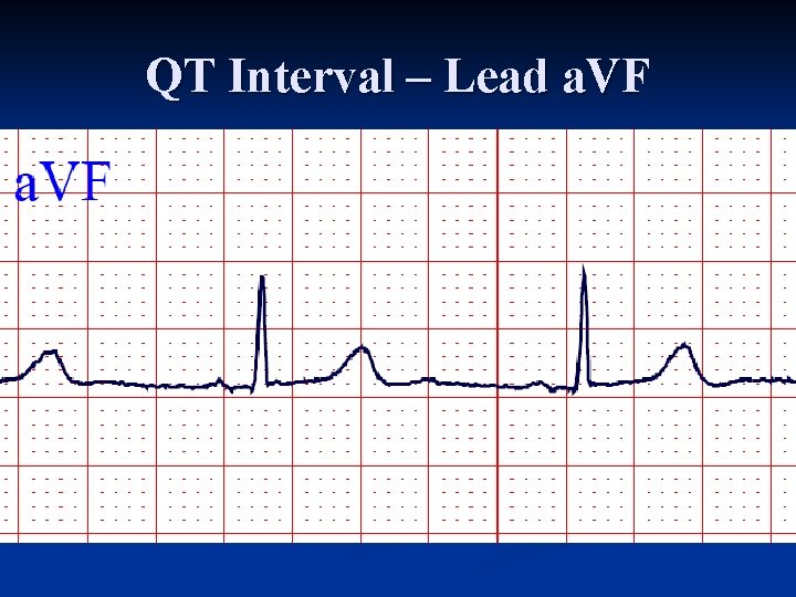 QT Interval – Lead a. VF 
