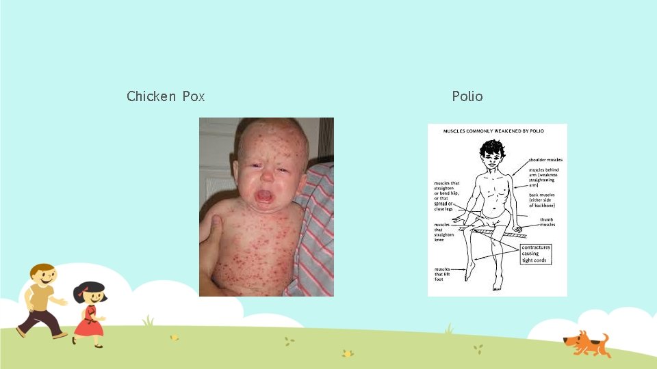 Chicken Pox Polio 