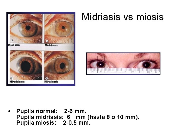 Midriasis vs miosis • Pupila normal: 2 -6 mm. Pupila midriasis: 6 mm (hasta