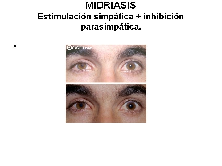 MIDRIASIS Estimulación simpática + inhibición parasimpática. • 