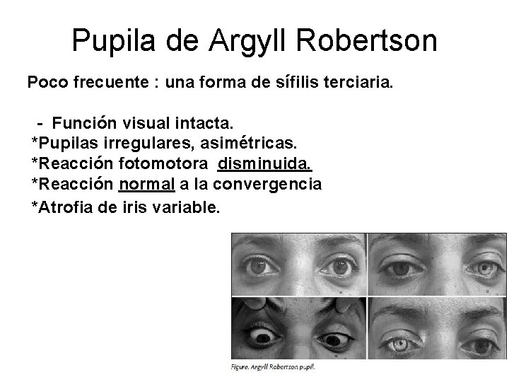 Pupila de Argyll Robertson Poco frecuente : una forma de sífilis terciaria. - Función