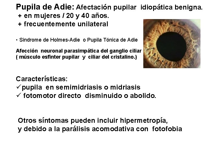 Pupila de Adie: Afectación pupilar idiopática benigna. + en mujeres / 20 y 40