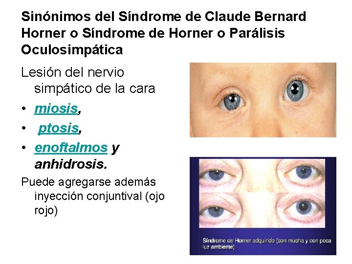Sinónimos del Síndrome de Claude Bernard Horner o Síndrome de Horner o Parálisis Oculosimpática