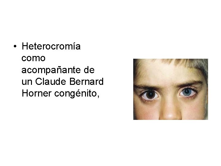  • Heterocromía como acompañante de un Claude Bernard Horner congénito, 