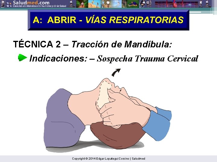 TÉCNICA 2 – Tracción de Mandíbula: Indicaciones: – Sospecha Trauma Cervical Copyright © 2014