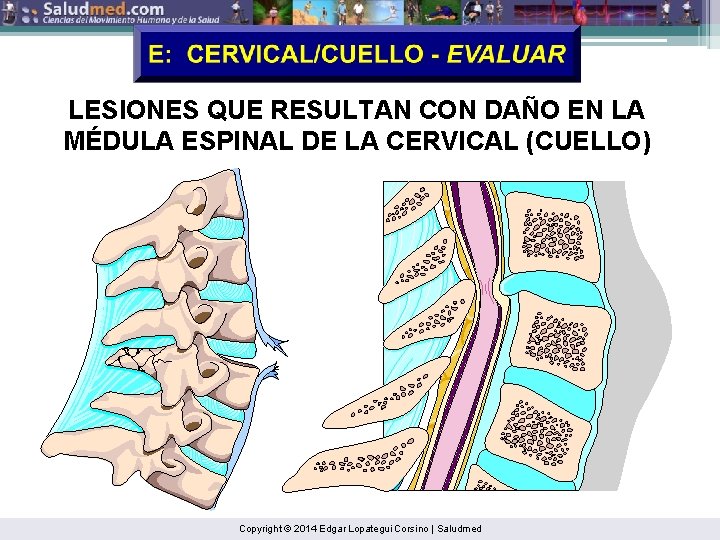 LESIONES QUE RESULTAN CON DAÑO EN LA MÉDULA ESPINAL DE LA CERVICAL (CUELLO) Copyright