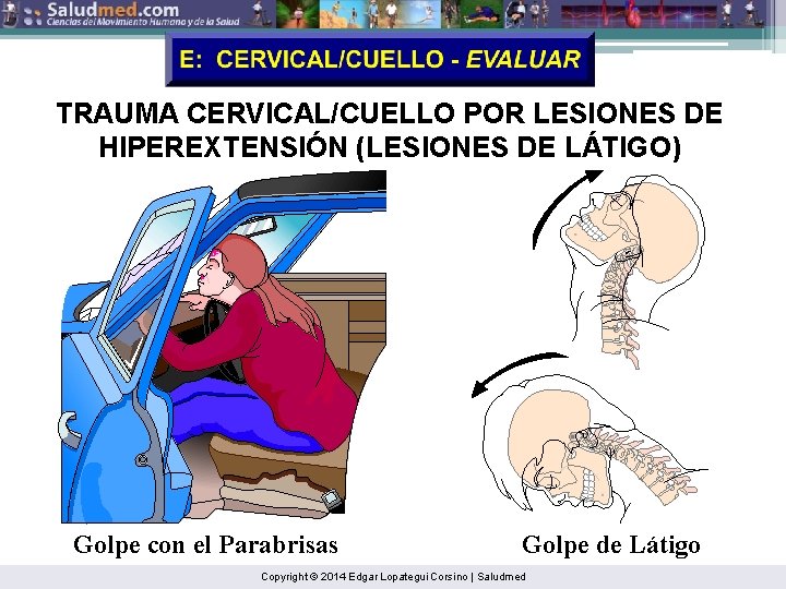 TRAUMA CERVICAL/CUELLO POR LESIONES DE HIPEREXTENSIÓN (LESIONES DE LÁTIGO) Golpe con el Parabrisas Golpe