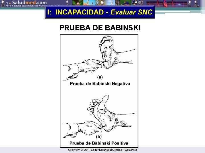 PRUEBA DE BABINSKI Copyright © 2014 Edgar Lopategui Corsino | Saludmed 