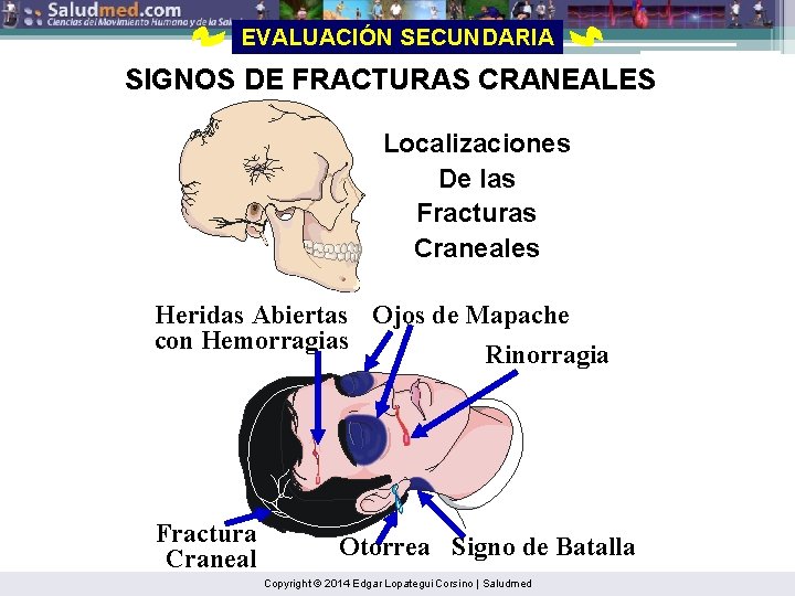 EVALUACIÓN SECUNDARIA SIGNOS DE FRACTURAS CRANEALES Localizaciones De las Fracturas Craneales Heridas Abiertas Ojos