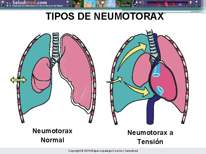 TIPOS DE NEUMOTORAX Neumotorax Normal Neumotorax a Tensión Copyright © 2014 Edgar Lopategui Corsino