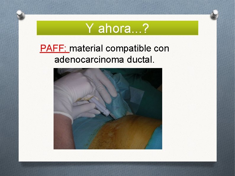 Y ahora. . . ? PAFF: material compatible con adenocarcinoma ductal. 