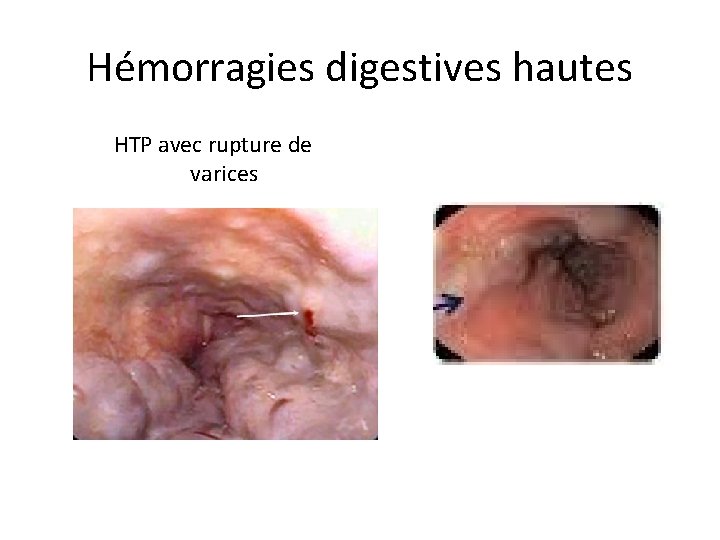 Hémorragies digestives hautes HTP avec rupture de varices 