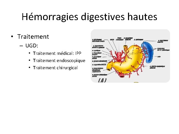 Hémorragies digestives hautes • Traitement – UGD: • Traitement médical: IPP • Traitement endoscopique