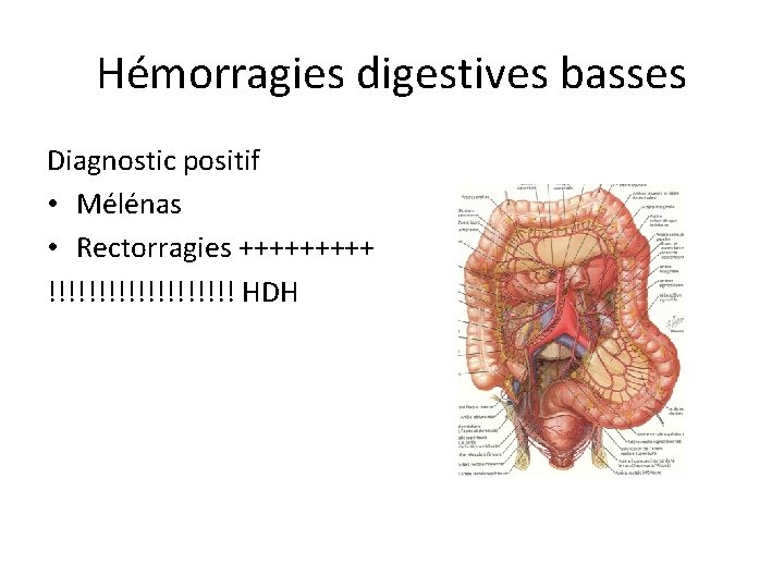 Hémorragies digestives basses Diagnostic positif • Mélénas • Rectorragies +++++ !!!!!!!!!! HDH 