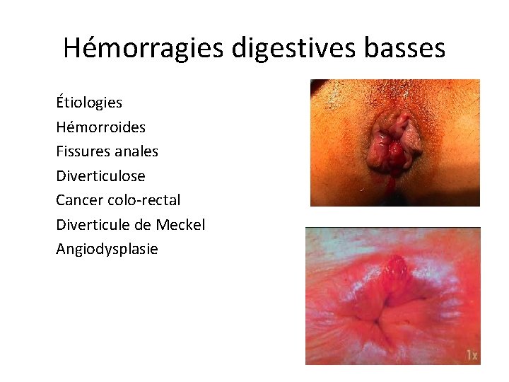 Hémorragies digestives basses Étiologies Hémorroides Fissures anales Diverticulose Cancer colo-rectal Diverticule de Meckel Angiodysplasie