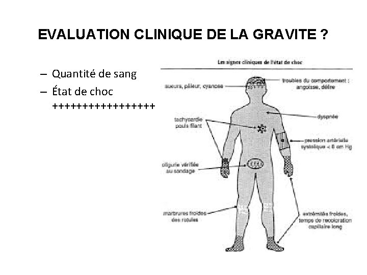 EVALUATION CLINIQUE DE LA GRAVITE ? – Quantité de sang – État de choc