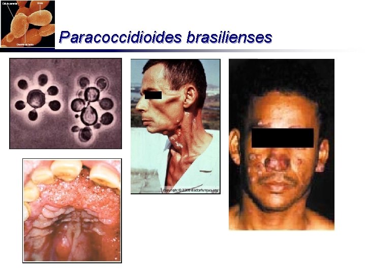 Paracoccidioides brasilienses 