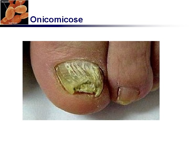 Onicomicose 