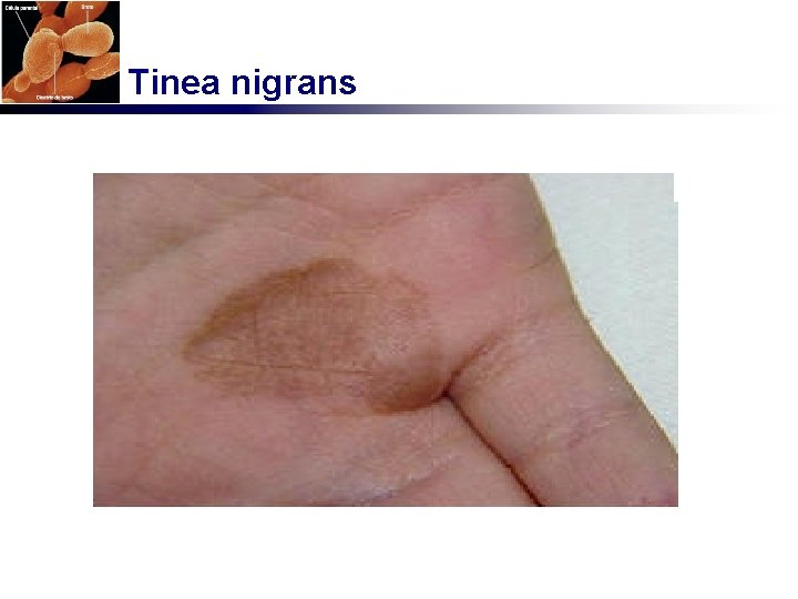 Tinea nigrans 
