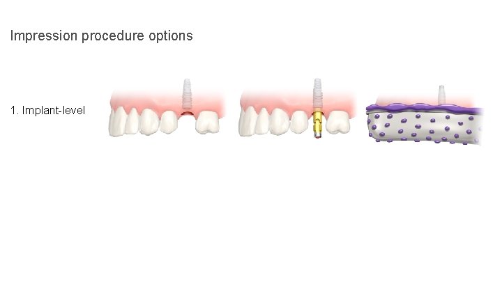 Impression procedure options 1. Implant-level 