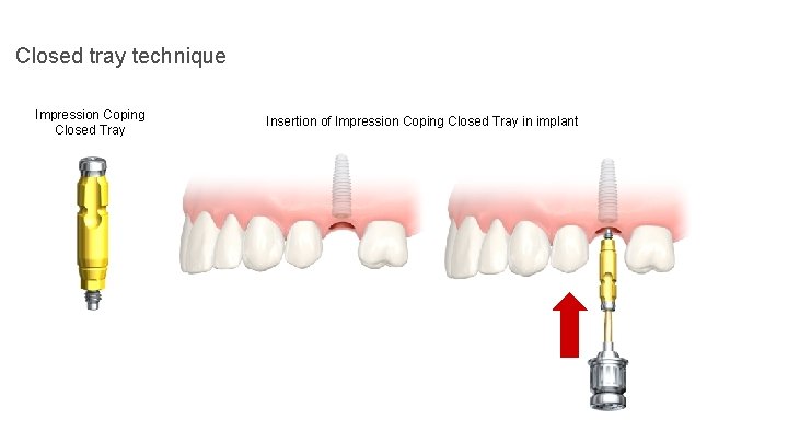 Closed tray technique Impression Coping Closed Tray Insertion of Impression Coping Closed Tray in