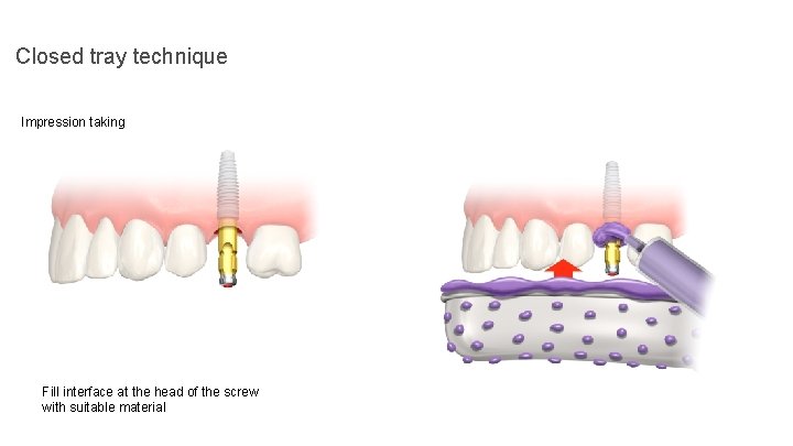 Closed tray technique Impression taking Fill interface at the head of the screw with