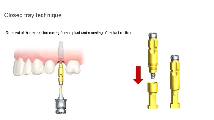 Closed tray technique Removal of the impression coping from implant and mounting of implant