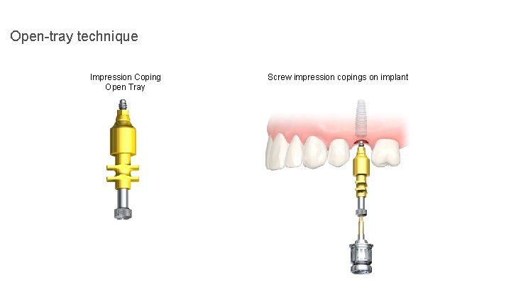 Open-tray technique Impression Coping Open Tray Screw impression copings on implant 