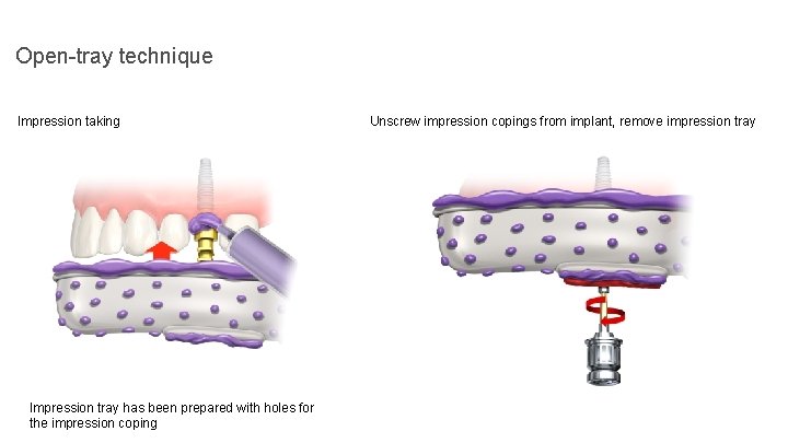 Open-tray technique Impression taking Impression tray has been prepared with holes for the impression