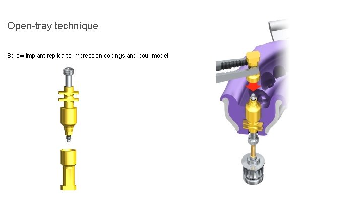 Open-tray technique Screw implant replica to impression copings and pour model 