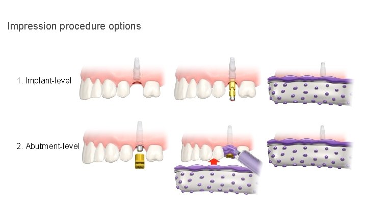 Impression procedure options 1. Implant-level 2. Abutment-level 