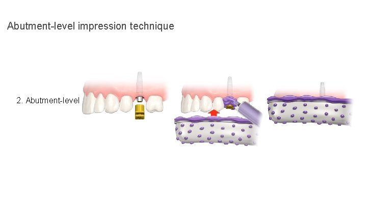 Abutment-level impression technique 2. Abutment-level 