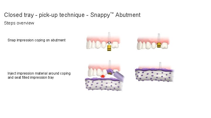 Closed tray - pick-up technique - Snappy™ Abutment Steps overview Snap impression coping on